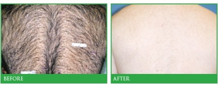 hairremoval21.jpg