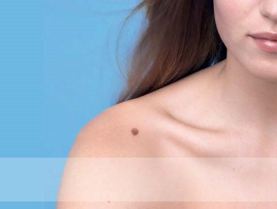 skin cancer awareness