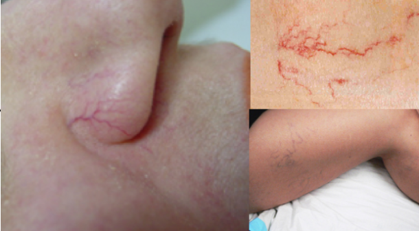Examples of the dreaded broken capillaries