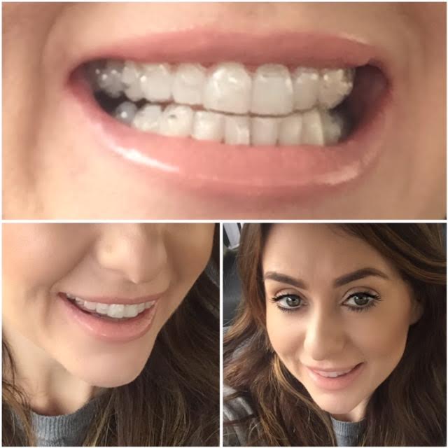 celebrity teeth invisaline clearbraces