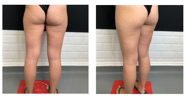 Cellfina Cellulite Treatment: Cost, Reviews, Treatment